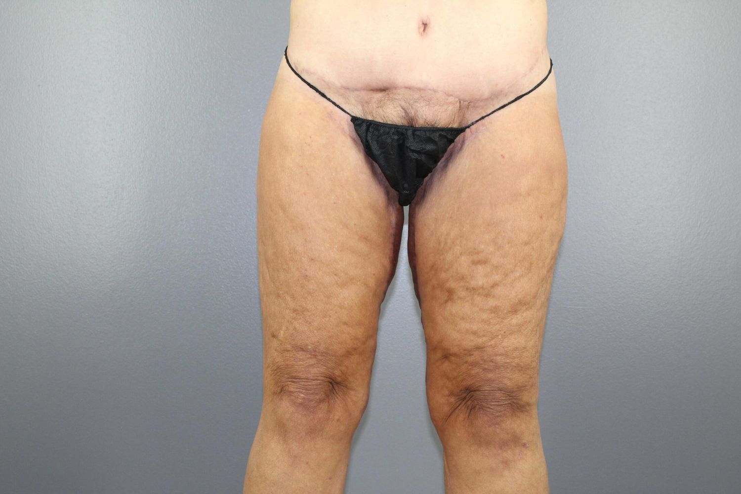 Thigh Lift Before & After