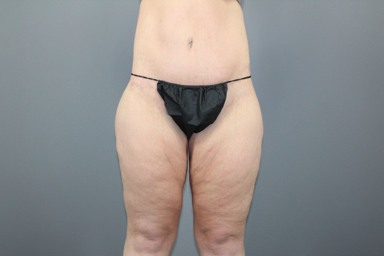 Thigh Lift Before & After