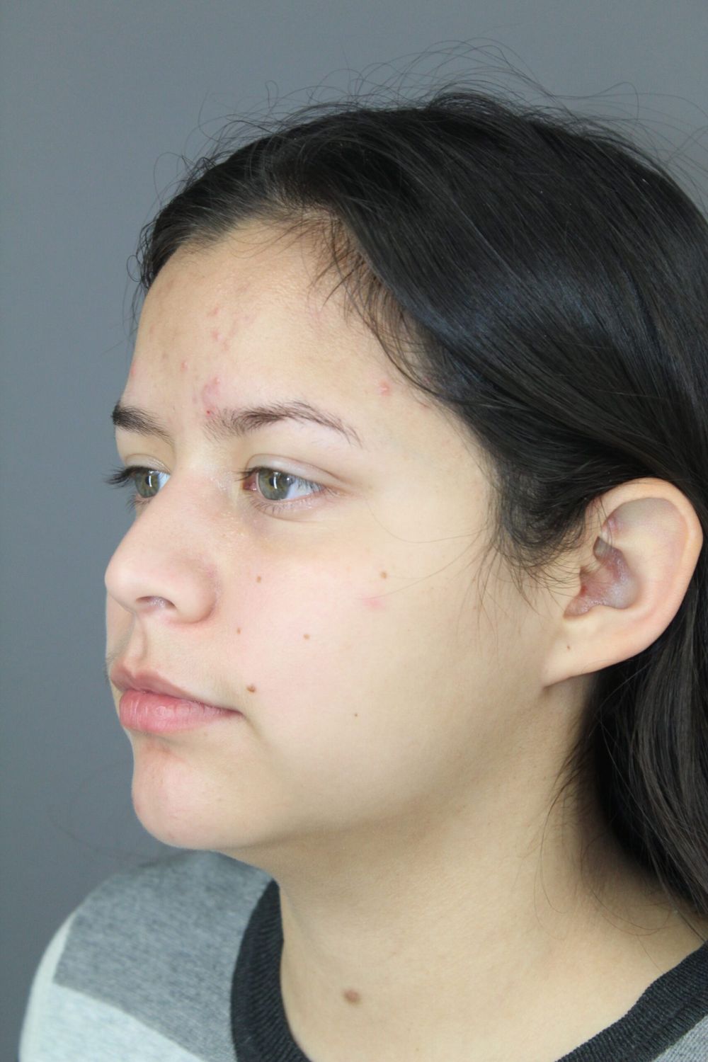 Neck Liposuction Before & After