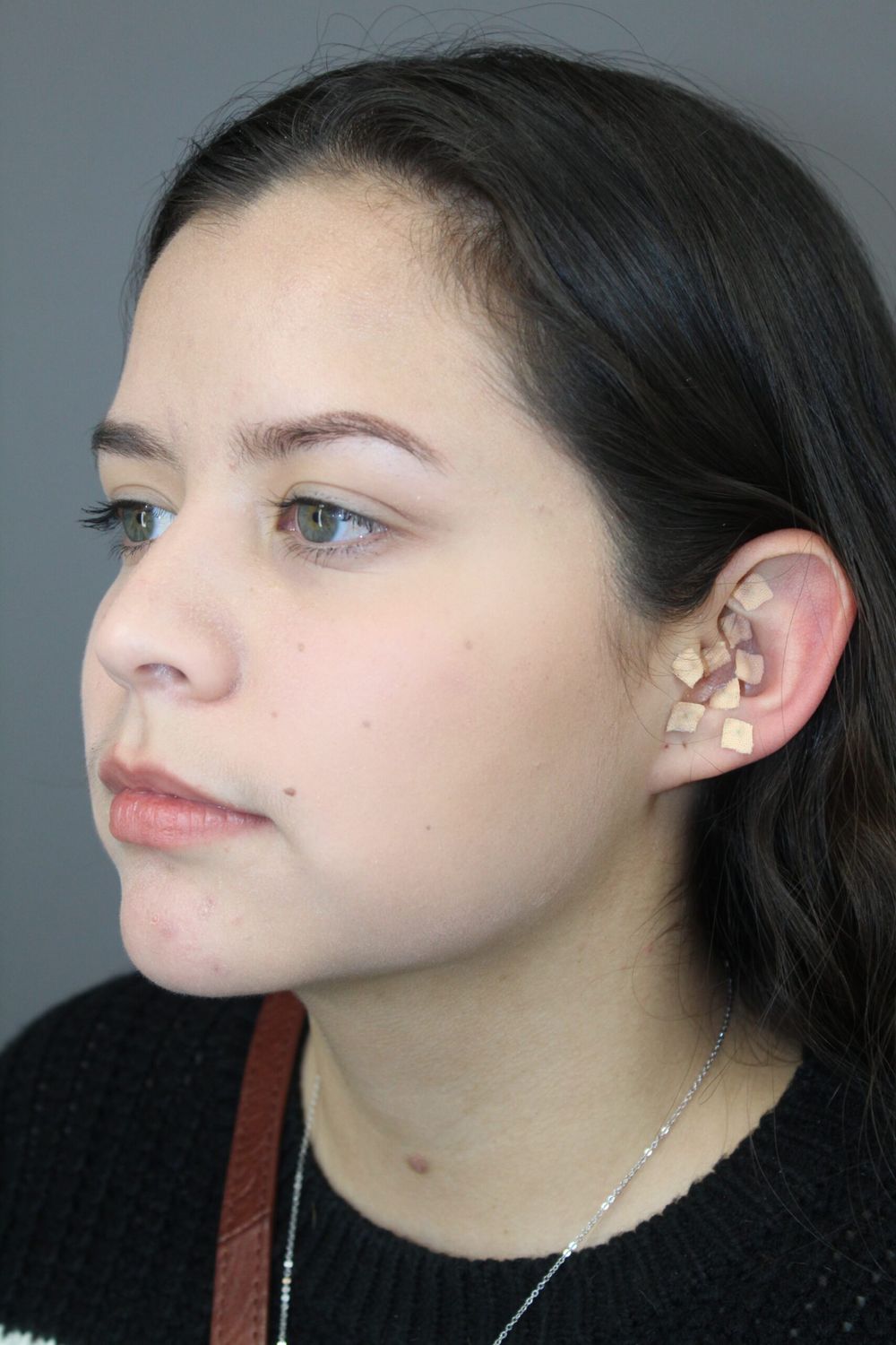 Neck Liposuction Before & After