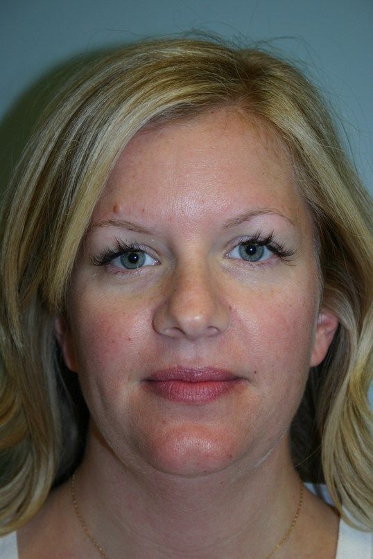 Neck Liposuction Before & After