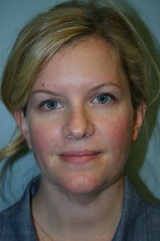 Neck Liposuction Before & After