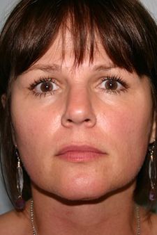 Neck Liposuction Before & After