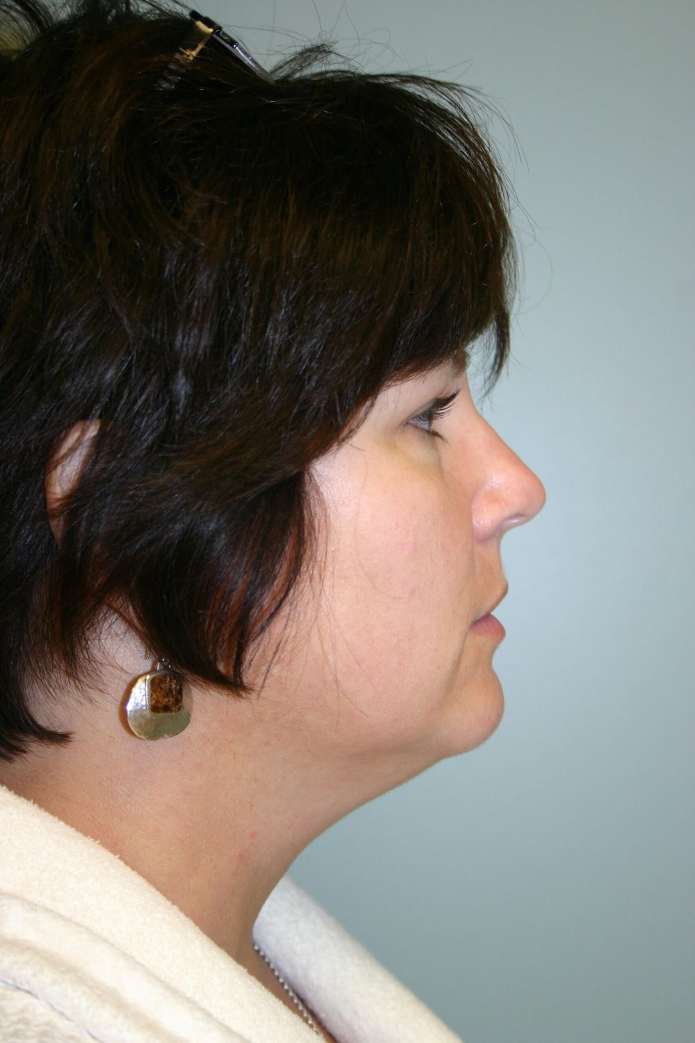 Neck Liposuction Before & After