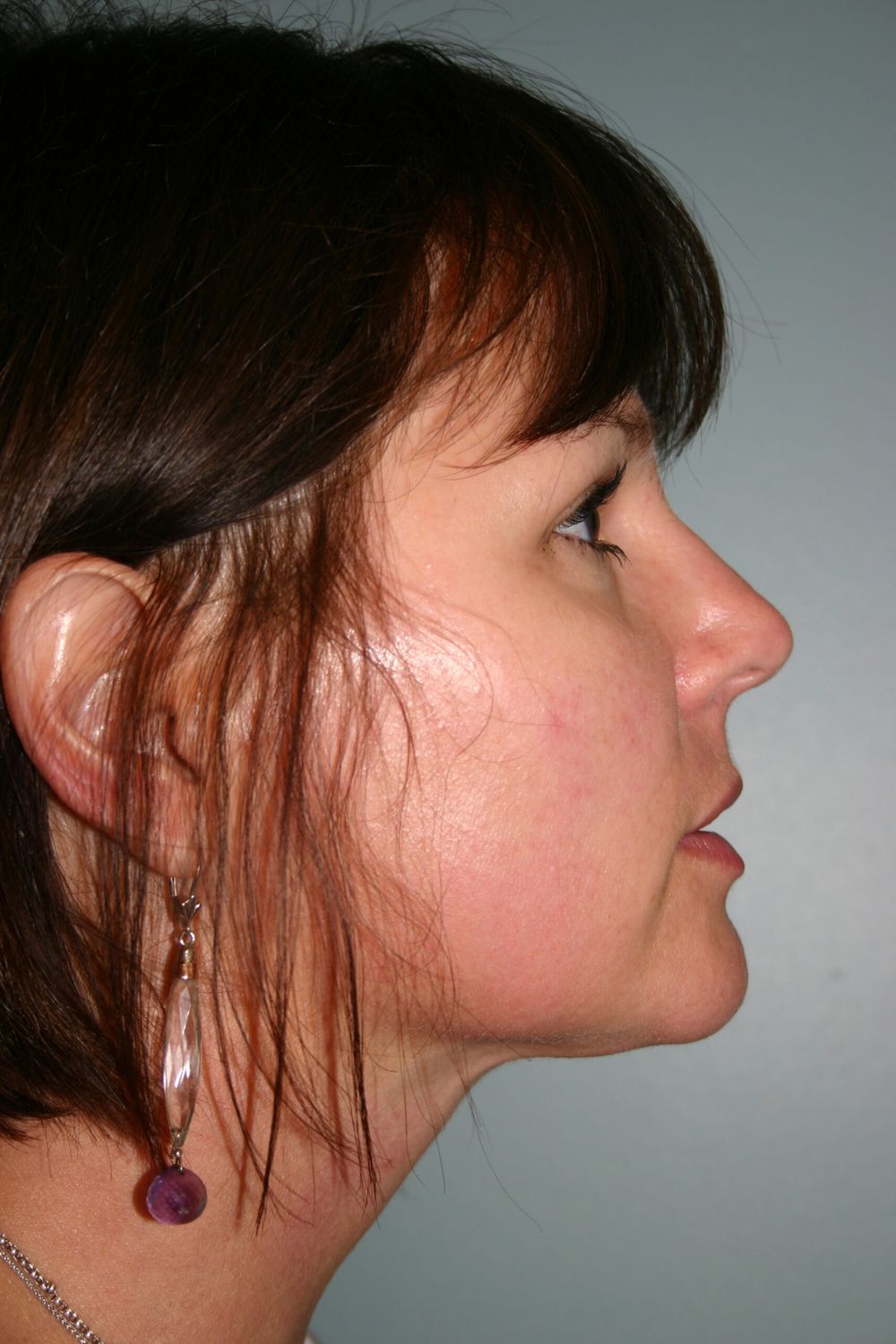 Neck Liposuction Before & After