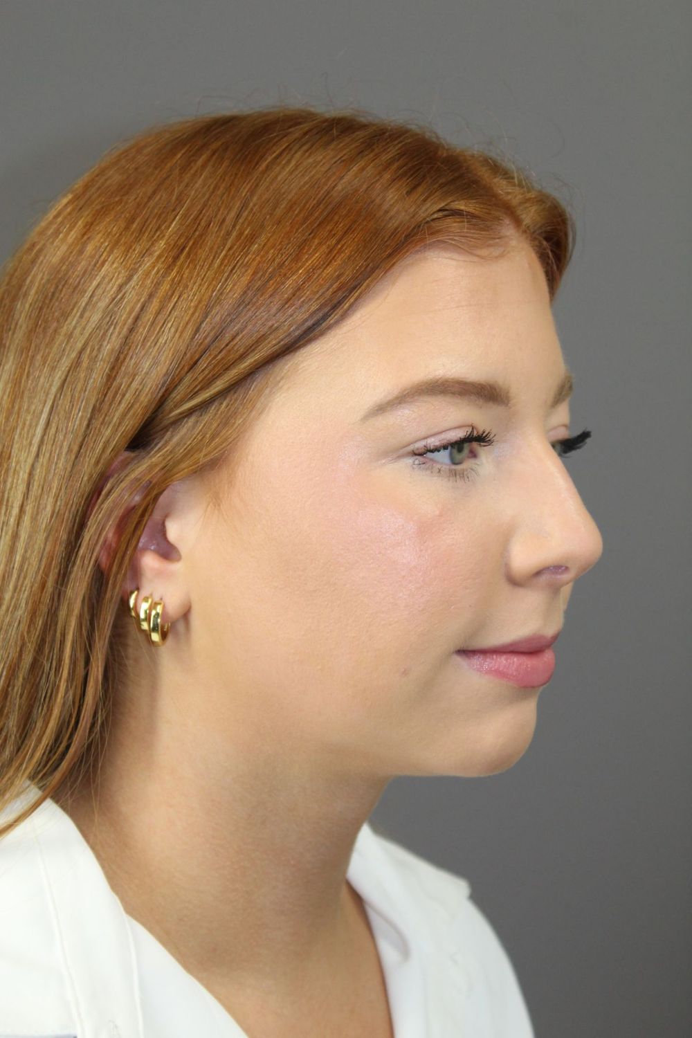 Neck Liposuction Before & After