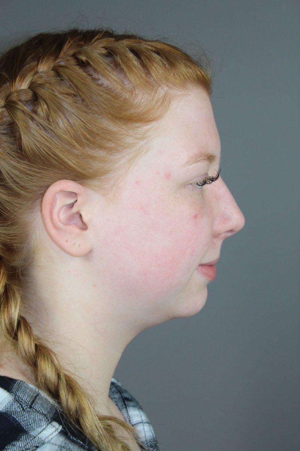 Neck Liposuction Before & After