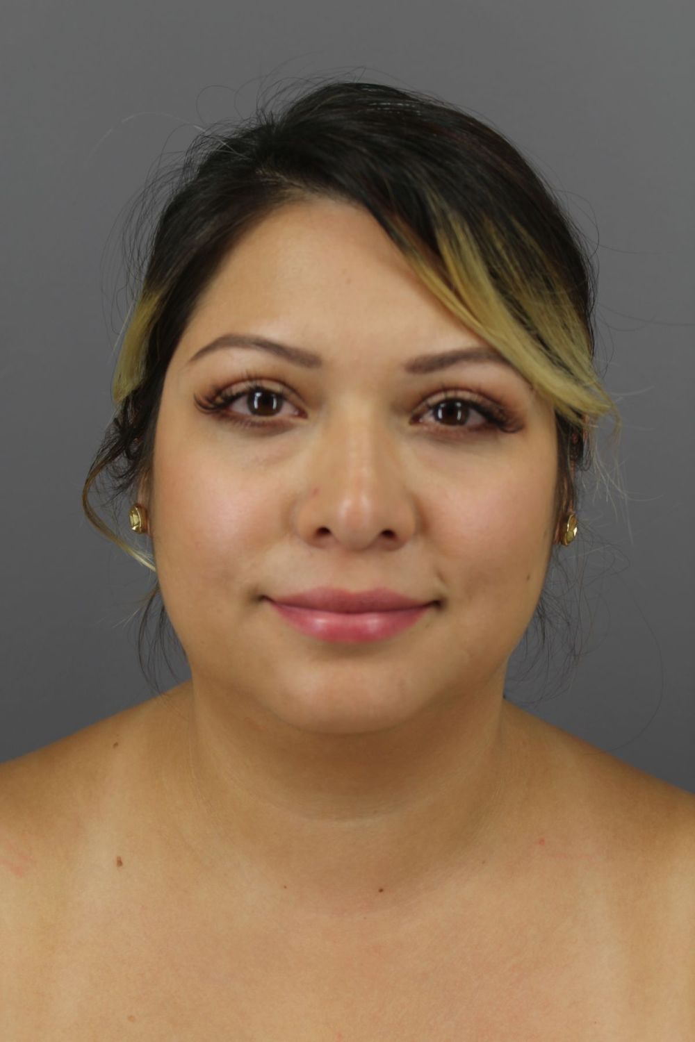 Neck Liposuction Before & After