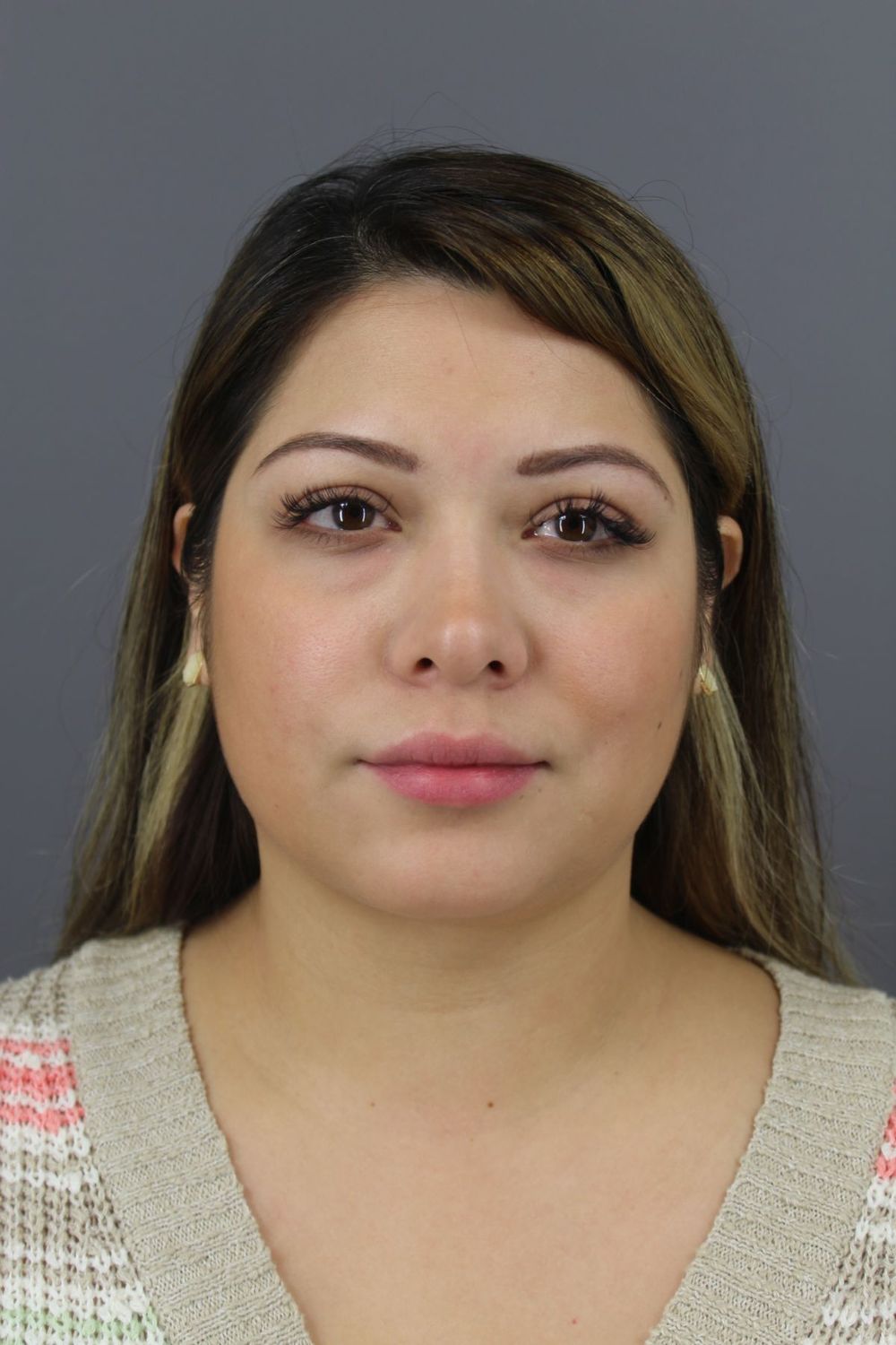 Neck Liposuction Before & After