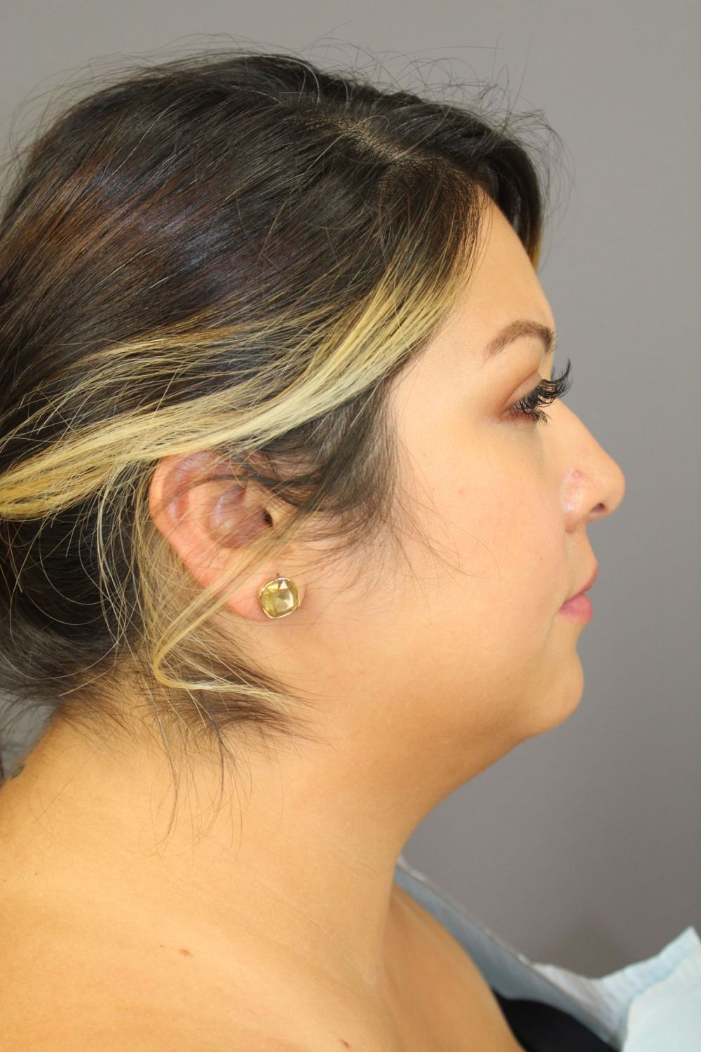 Neck Liposuction Before & After