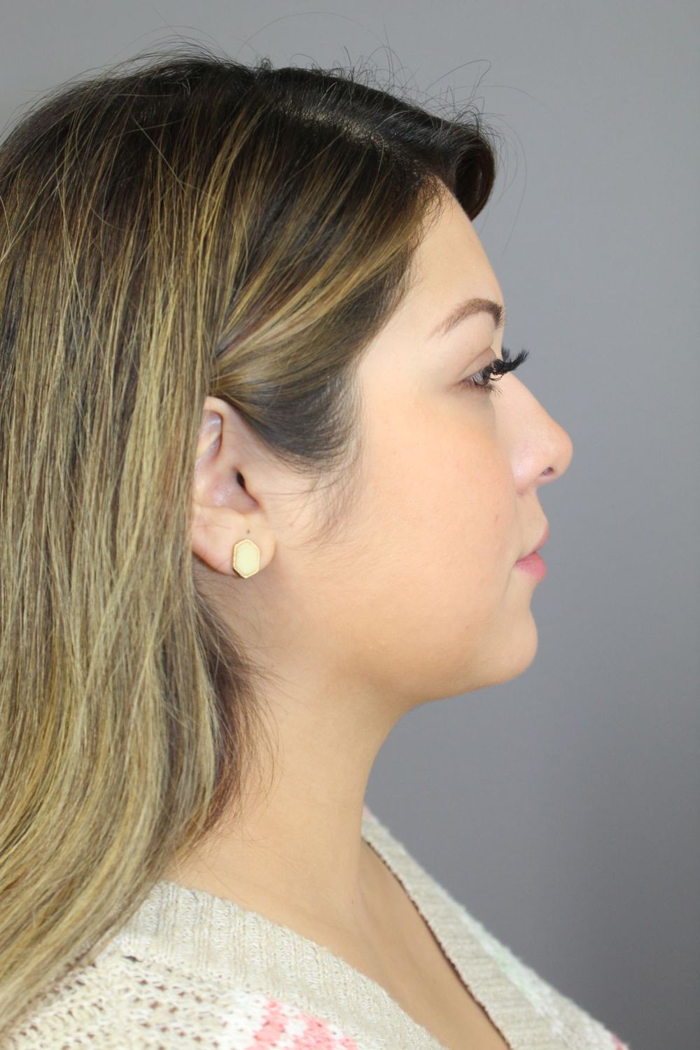 Neck Liposuction Before & After