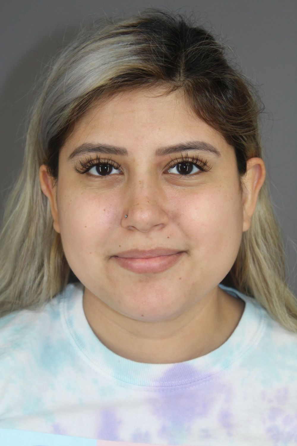 Neck Liposuction Before & After