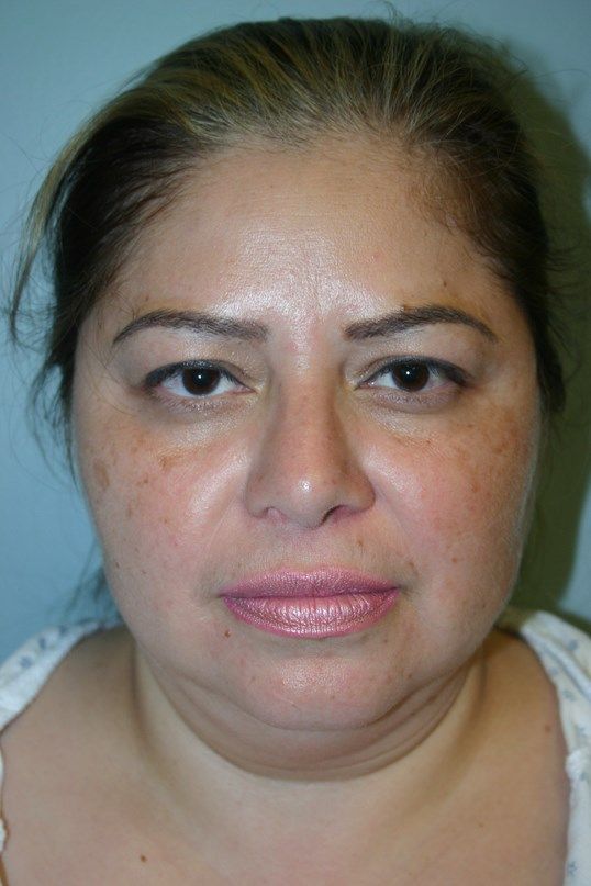 Neck Liposuction Before & After