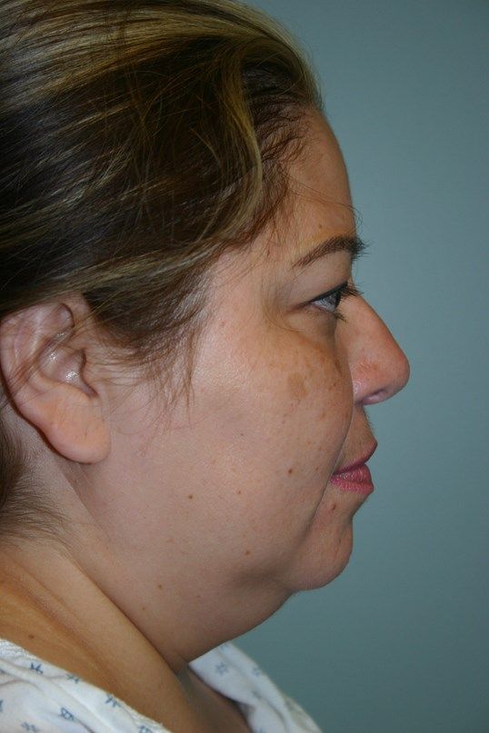 Neck Liposuction Before & After