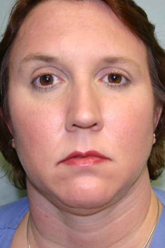 Neck Liposuction Before & After