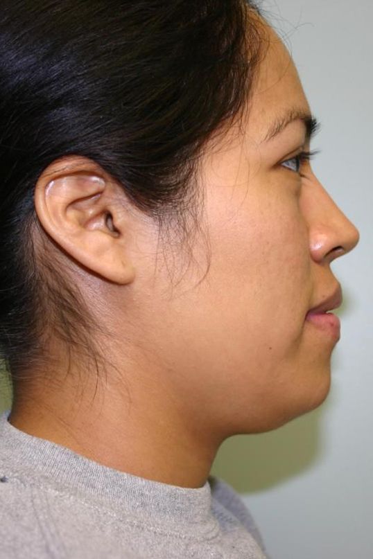 Neck Liposuction Before & After