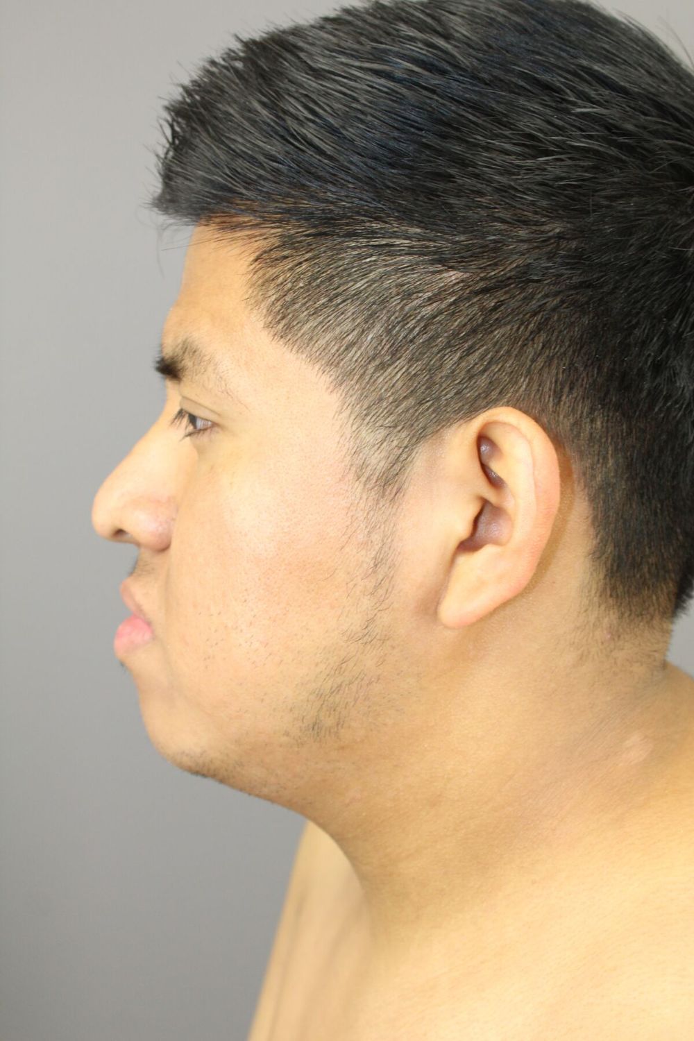 Neck Liposuction Before & After