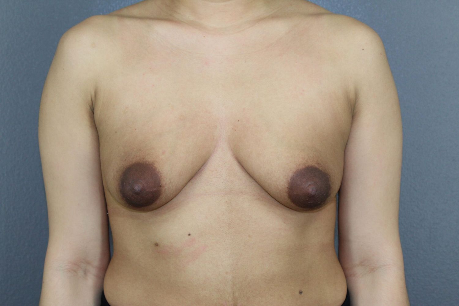 Breast Augmentation Before & After