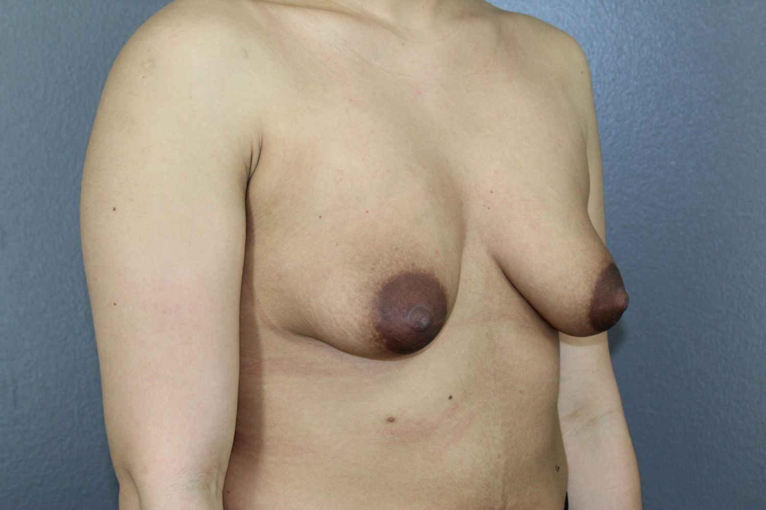 Breast Augmentation Before & After