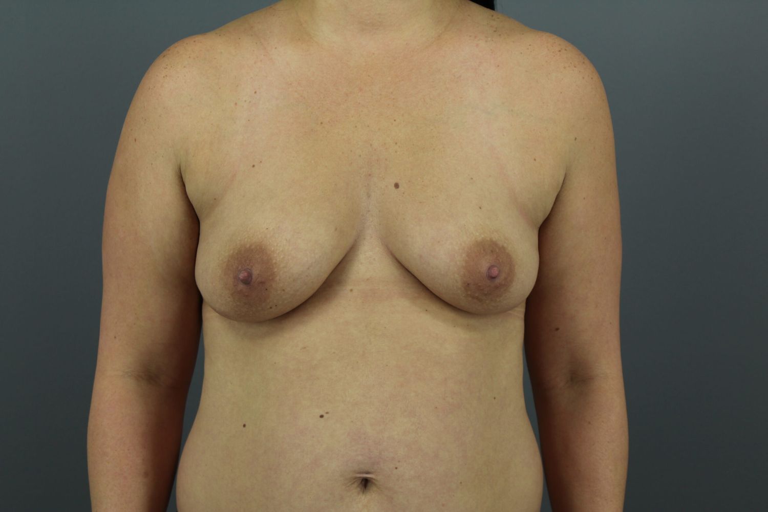 Breast Augmentation Before & After