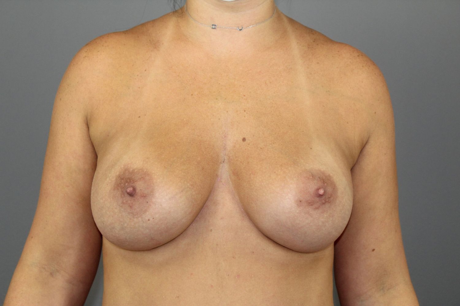 Breast Augmentation Before & After