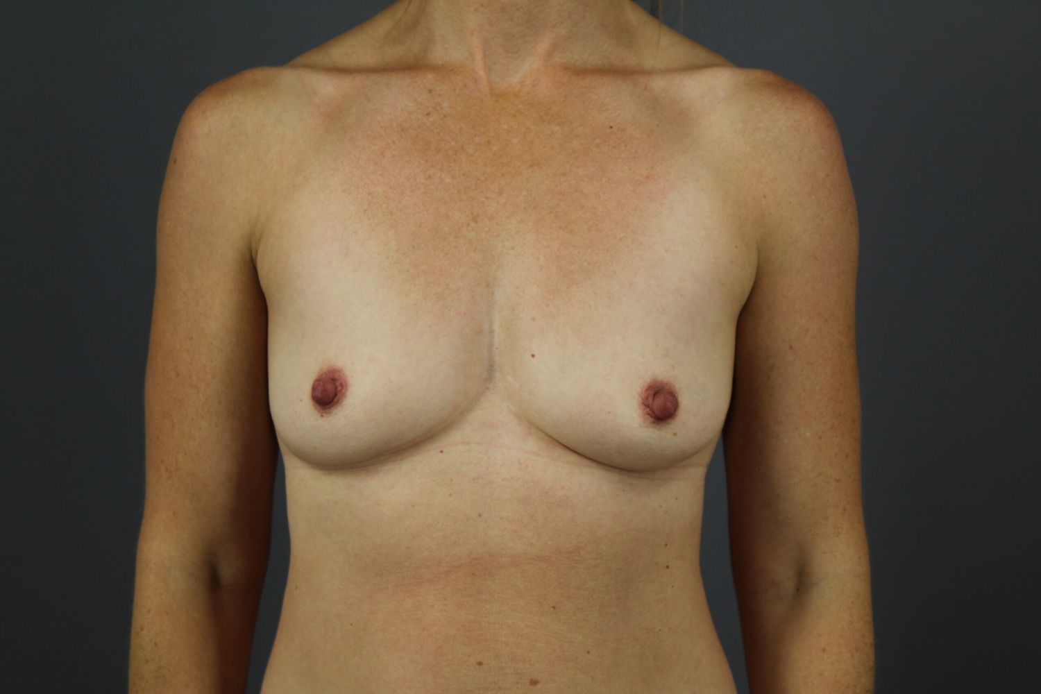 Breast Augmentation Before & After