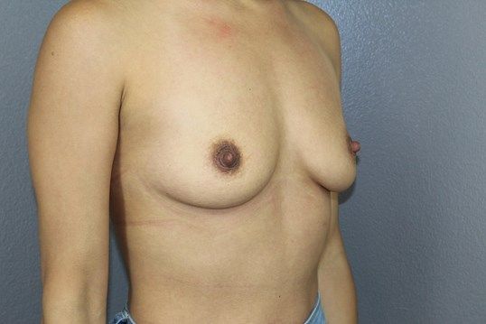 Breast Augmentation Before & After