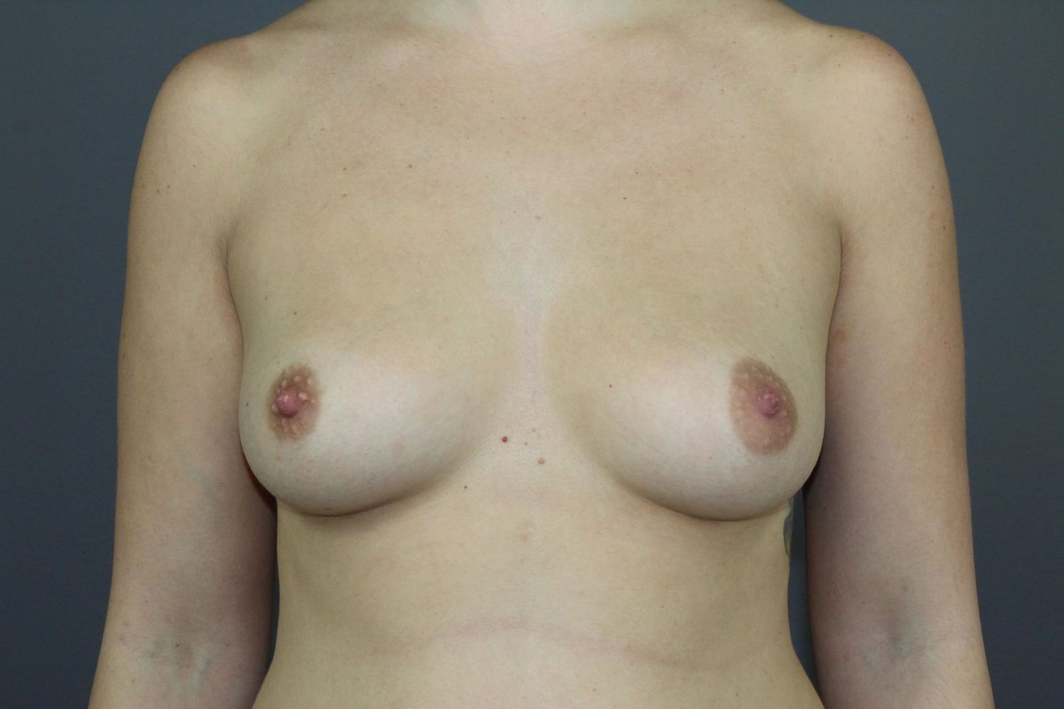 Breast Augmentation Before & After