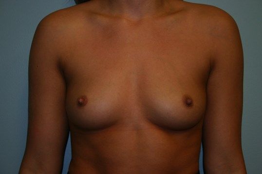 Breast Augmentation Before & After