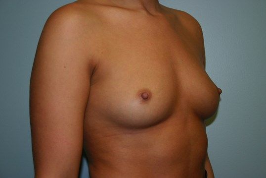 Breast Augmentation Before & After