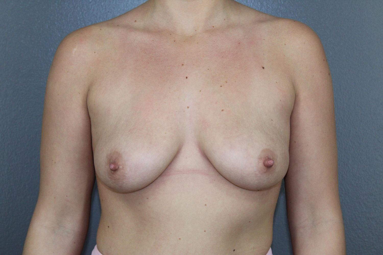 Breast Augmentation Before & After