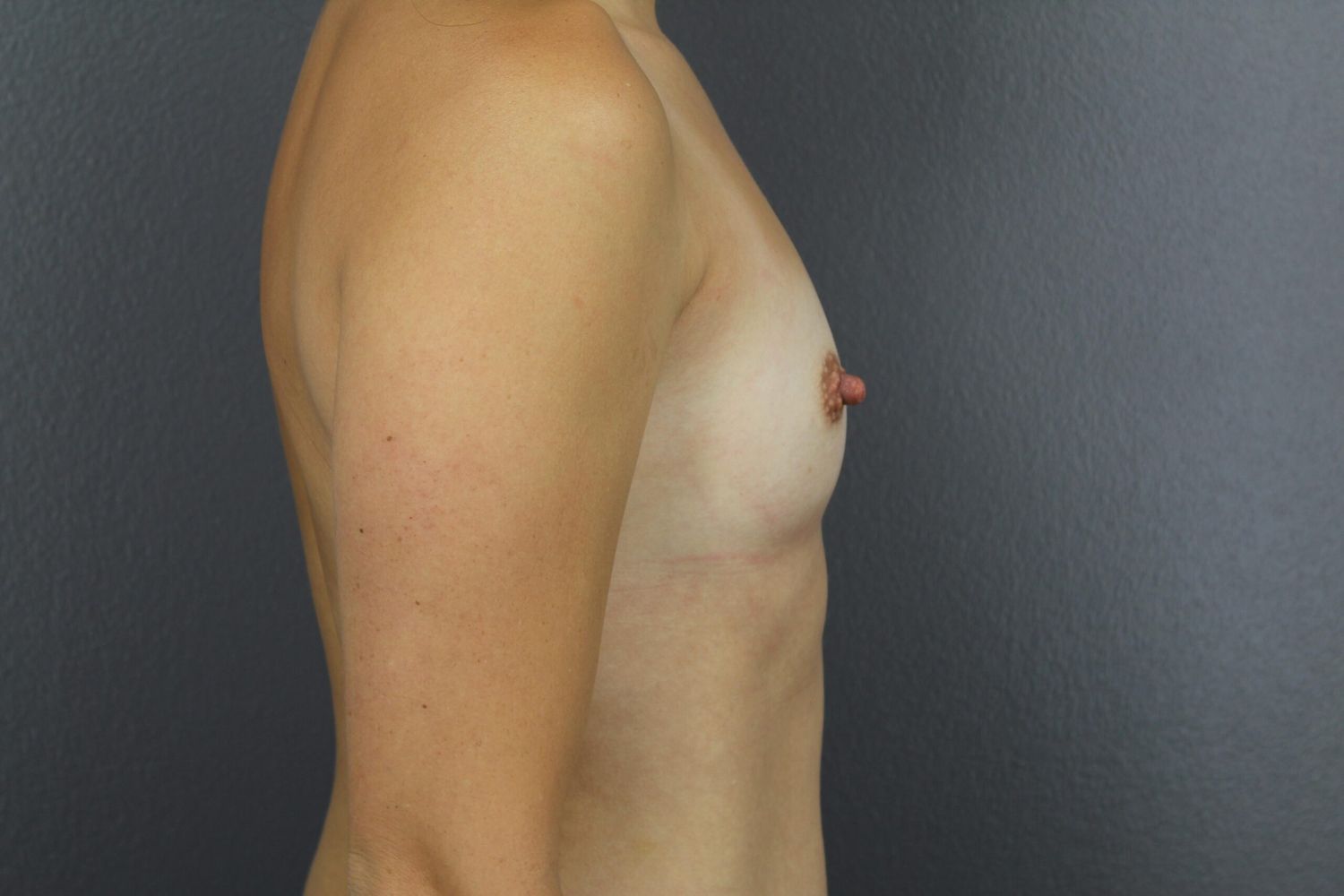Breast Augmentation Before & After