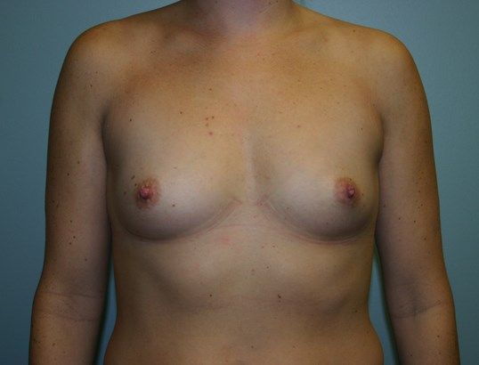 Breast Augmentation Before & After