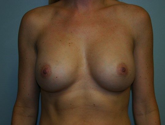 Breast Augmentation Before & After