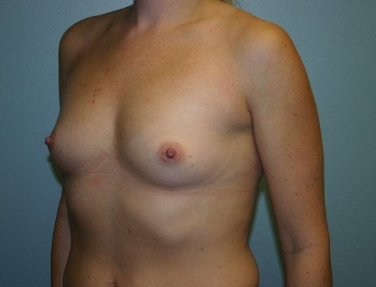 Breast Augmentation Before & After