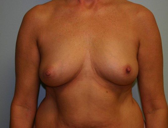 Breast Augmentation Before & After
