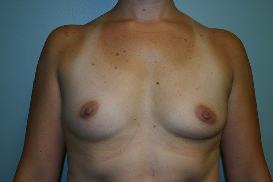 Breast Augmentation Before & After