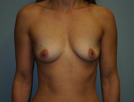 Breast Augmentation Before & After