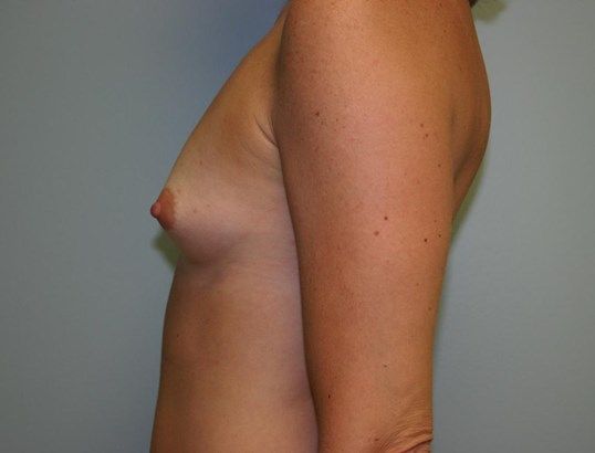Breast Augmentation Before & After