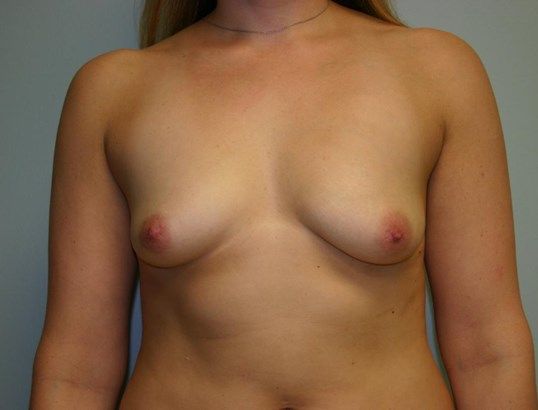 Breast Augmentation Before & After