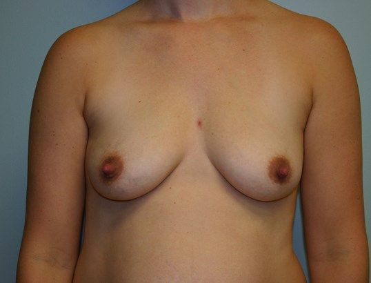 Breast Augmentation Before & After
