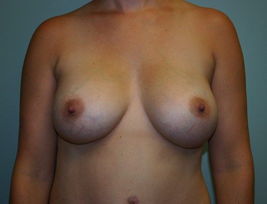 Breast Augmentation Before & After