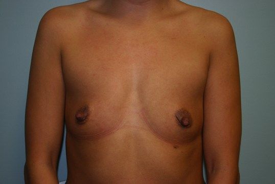 Breast Augmentation Before & After