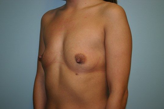 Breast Augmentation Before & After
