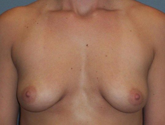 Breast Augmentation Before & After