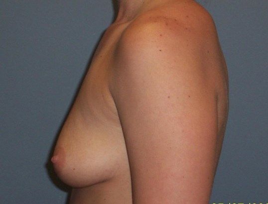 Breast Augmentation Before & After