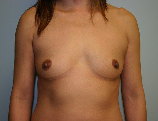 Breast Augmentation Before & After