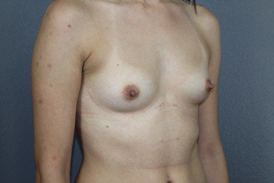 Breast Augmentation Before & After