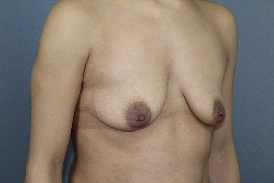 Breast Augmentation Before & After