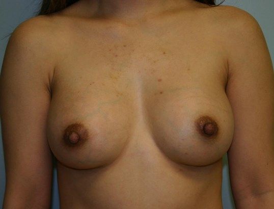 Breast Augmentation Before & After